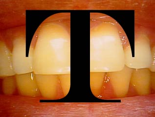 Two front teeth with majuscule letter T in large type